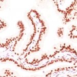 FFPE human prostate carcinoma sections stained with 100 ul anti-Androgen Receptor (clone AR441 + DHTR/882) at 1:50. HIER epitope retrieval prior to staining was performed in 10mM Tris 1mM EDTA, pH 9.0.